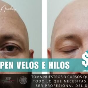 Dermapen Velos e Hilos de Colágeno